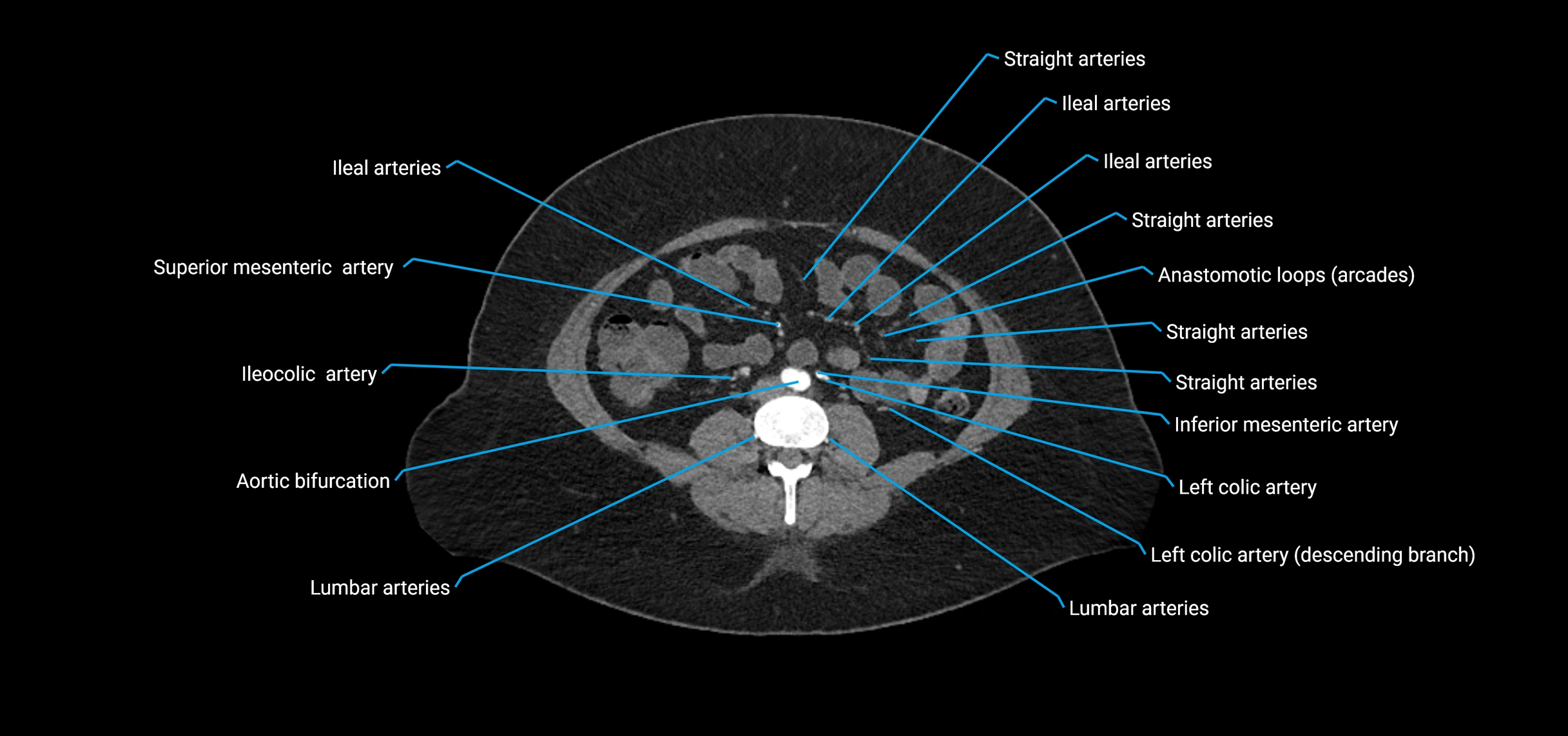 CTA abdomen axial cross sectional anatomy labelled image_122 (2).webp